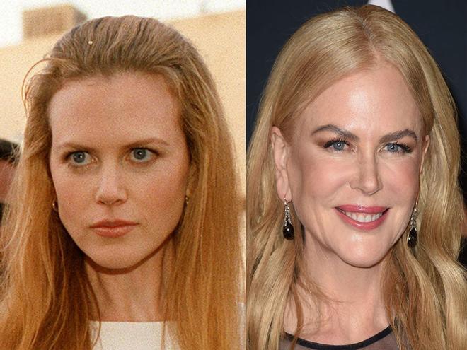 Nicole Kidman antes y después de las operaciones