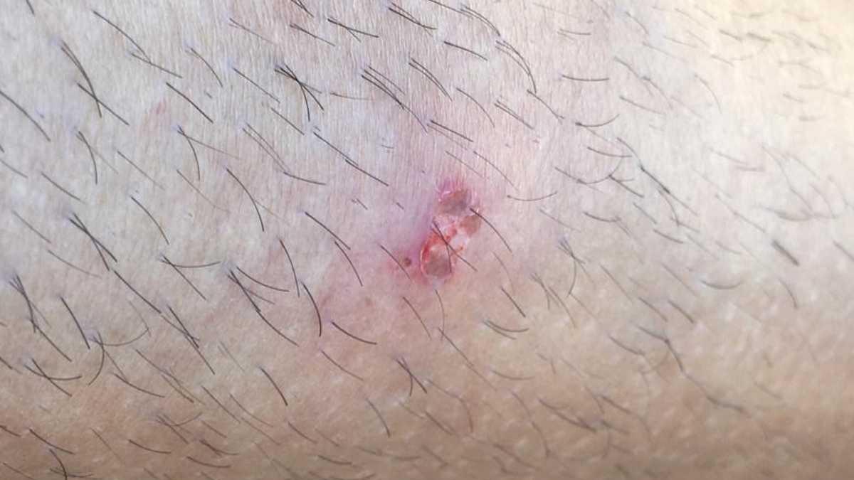 Herida causada a uno de los bañistas por una oblada