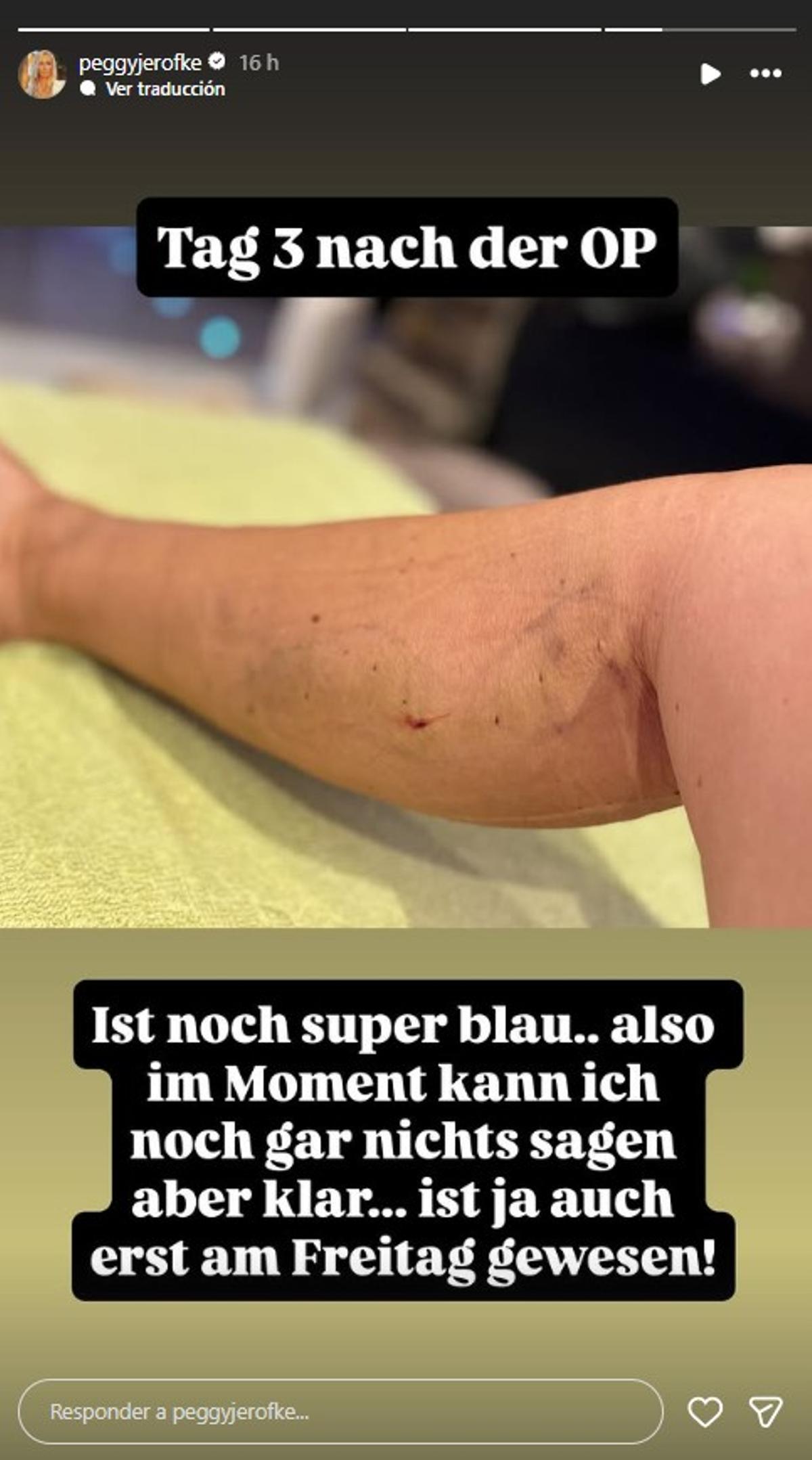 Noch ist Peggy Jerofkes Fuß etwas blau.