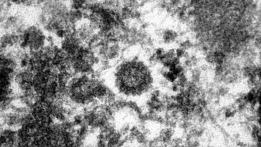 Micrografía del SARS-CoV-2 en las venas
