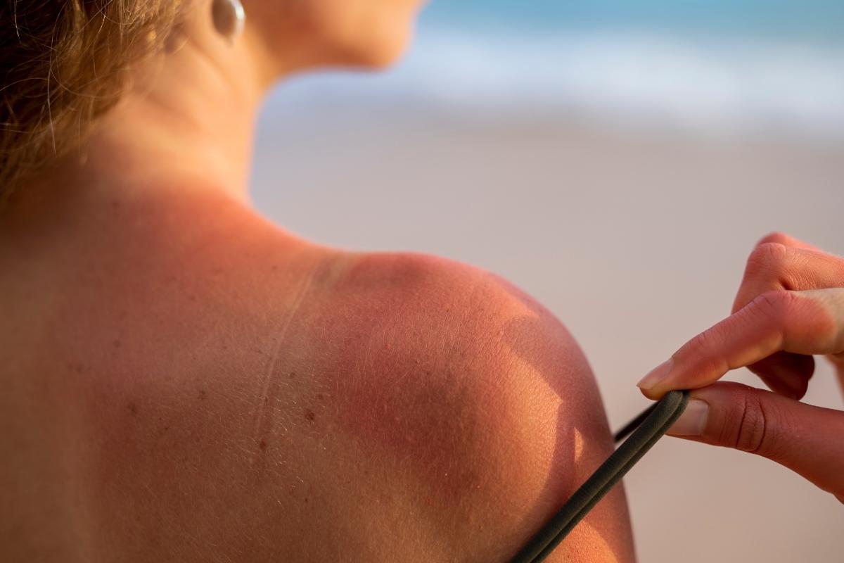 Las quemaduras solares aumentan el riesgo de padecer cáncer de piel