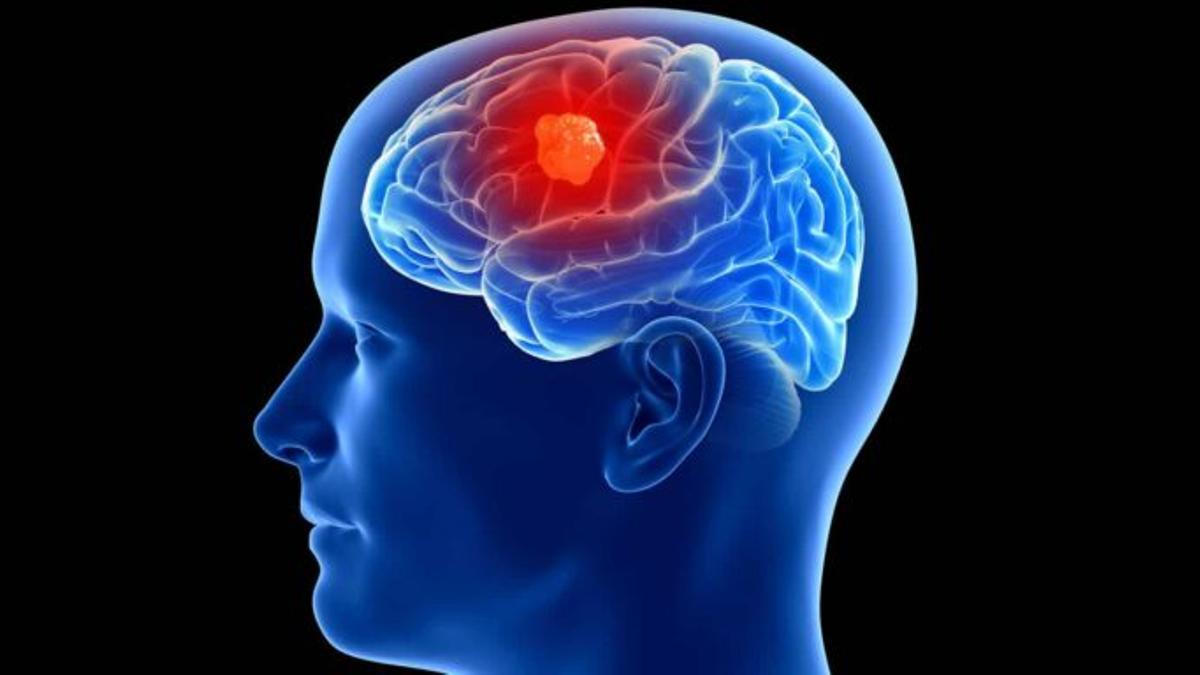 Día Internacional de los Tumores Cerebrales ¿Cuáles son los signos de la presencia de un tumor?