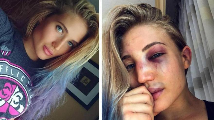 La modelo y luchadora Yankova muestra en Instagram su cara tras una pelea