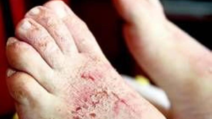 Un hombre denuncia lesiones en sus pies por unos zapatos &quot;tóxicos&quot;