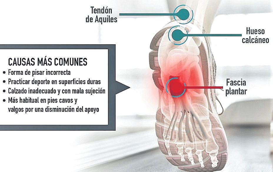 Esquema que muestra la zona afectada por la fascitis