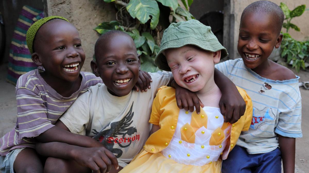 Guinea, primer país en aprobar una ley de protección a los albinos.