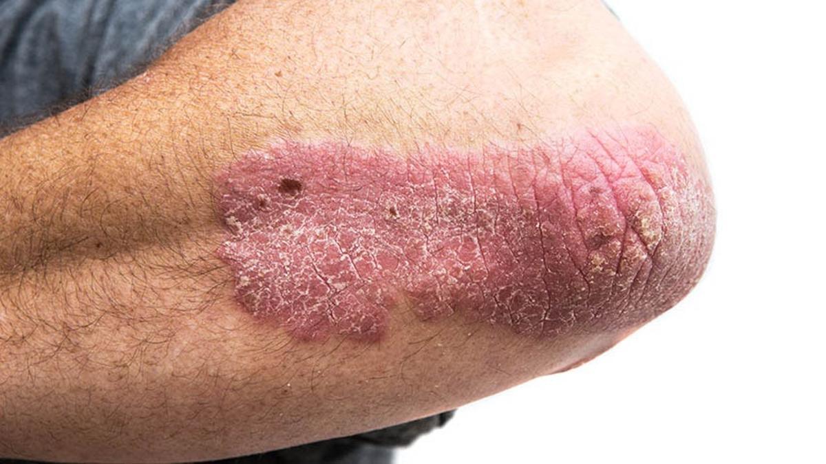 Típica &quot;herida&quot; de la psoriasis en el codo