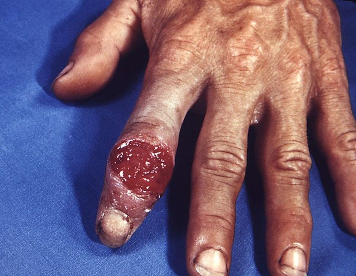 Chancro sifilítico, el síntoma de la sífilis