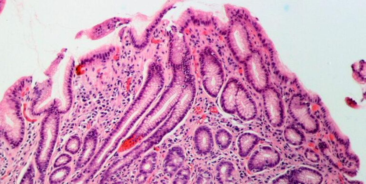 Helicobacter pylori: Así es la infección que padece la mitad de la población mundial