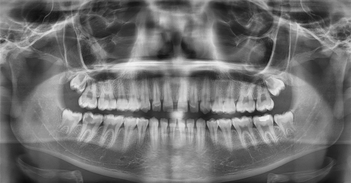 Radiografía dental utilizada en el trabajo.