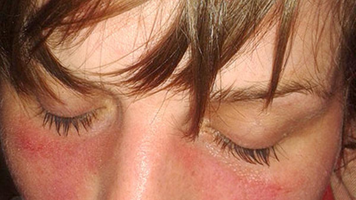 Lupus, así es la enfermedad “rara” que afecta sobre todo a las mujeres y podría provocar el sol