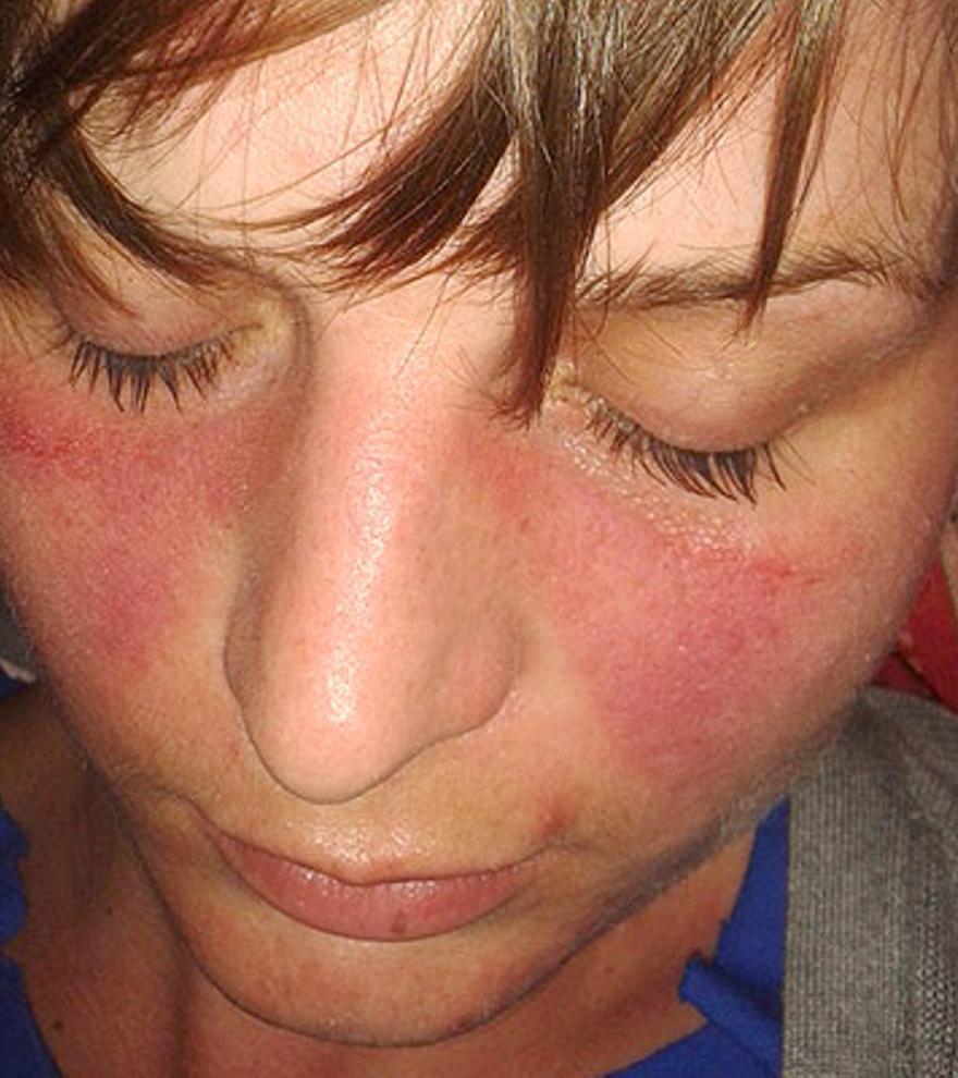Lupus, así es la enfermedad &quot;rara&quot; que afecta sobre todo a las mujeres y podría provocar el sol