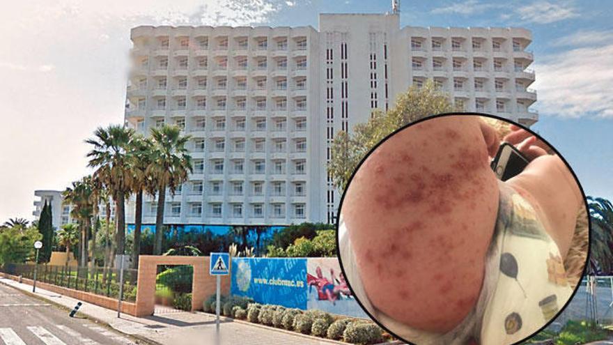 50 Kinder in Hotel auf Mallorca von Virus infiziert
