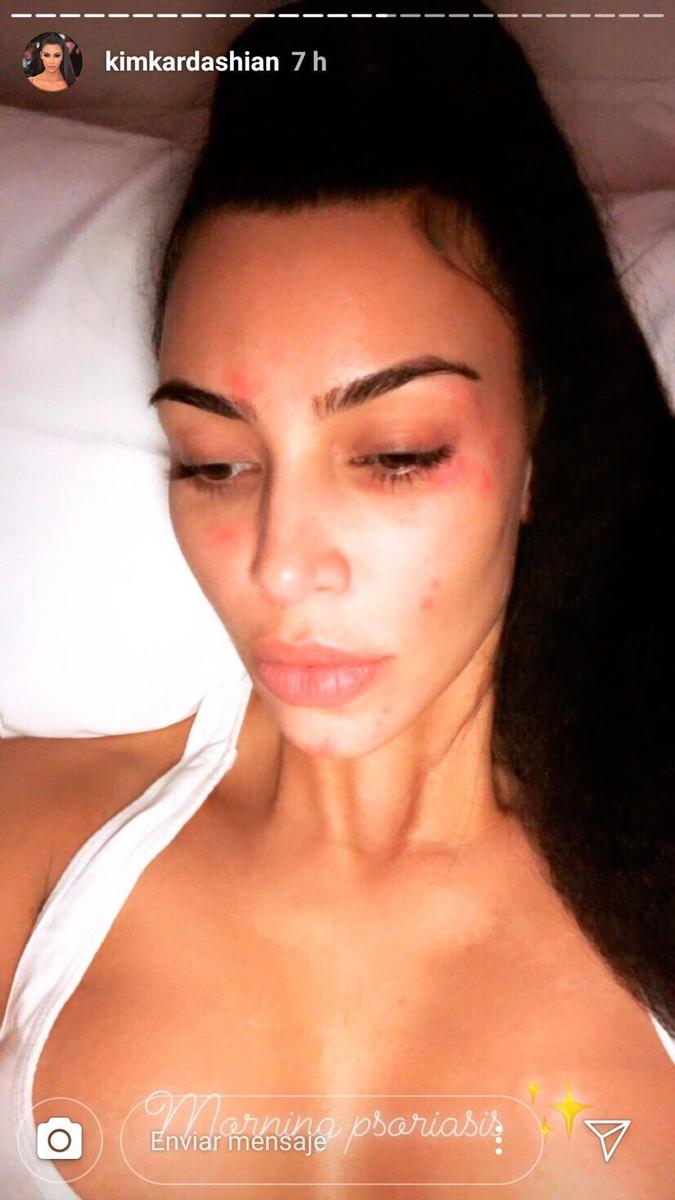 Kim Kardashian sufre psoriaris y nos lo enseña