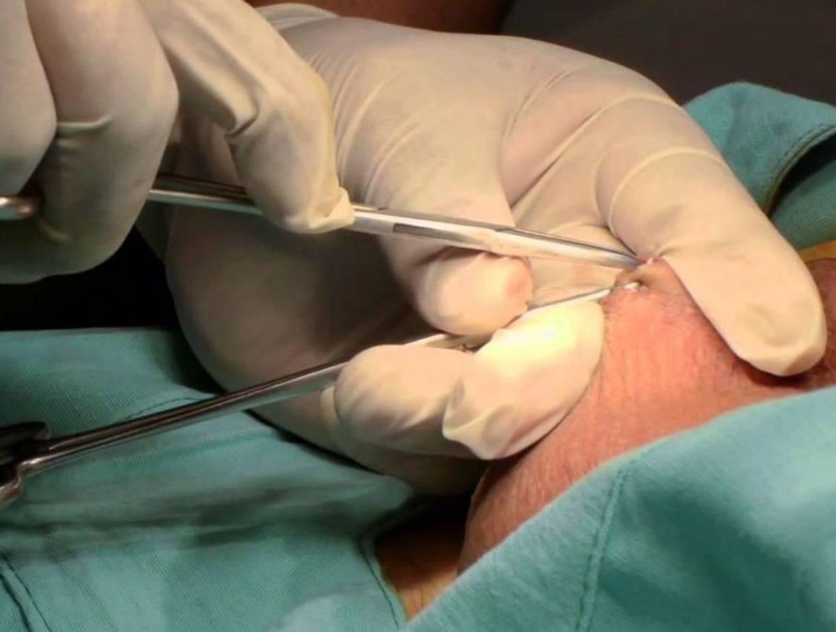 Vasectomía sin bisturí, rápida, eficaz y poco agresiva.