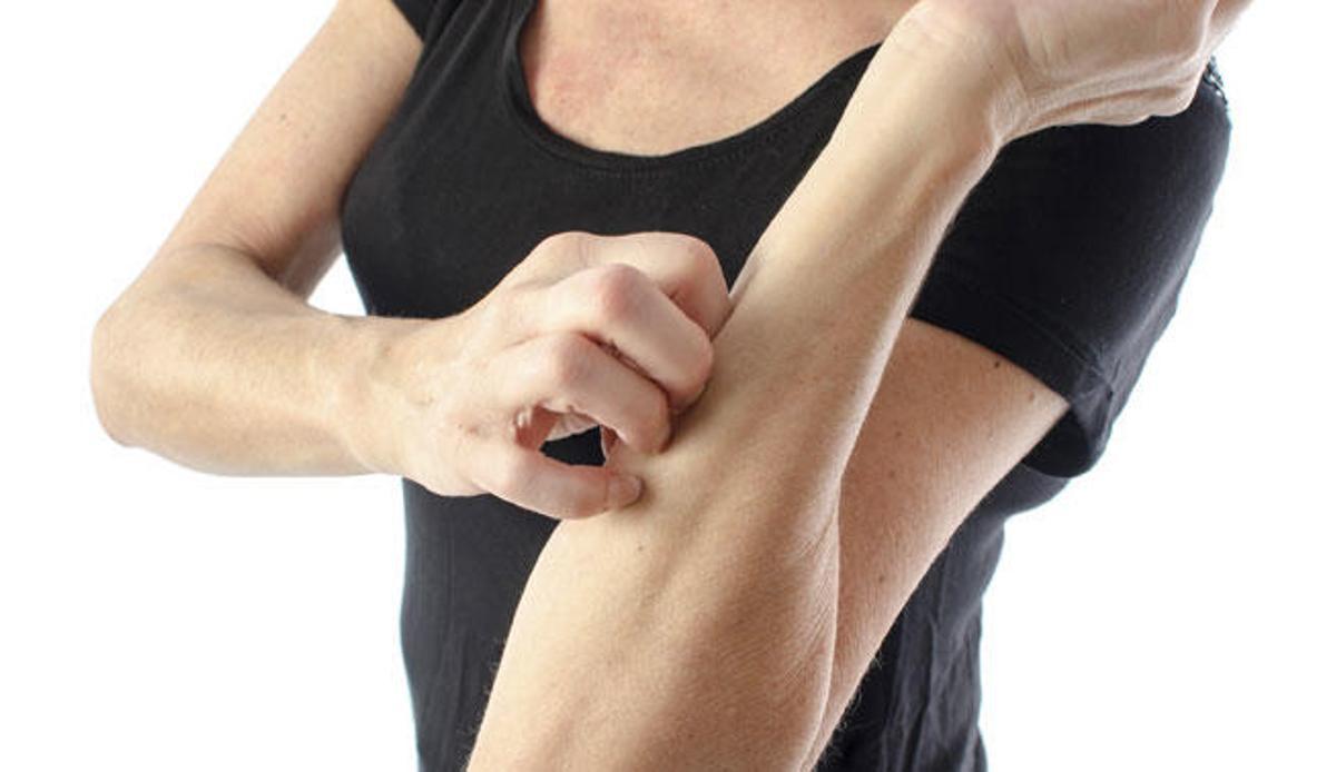 El estrés puede provocar urticaria crónica.