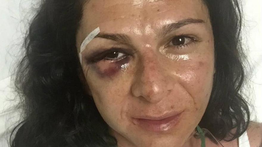La atleta Ana Guevara sufre una fractura de pómulo tras ser agredida