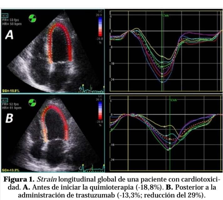 Imagen para detectar la posible cardiotoxicidad.