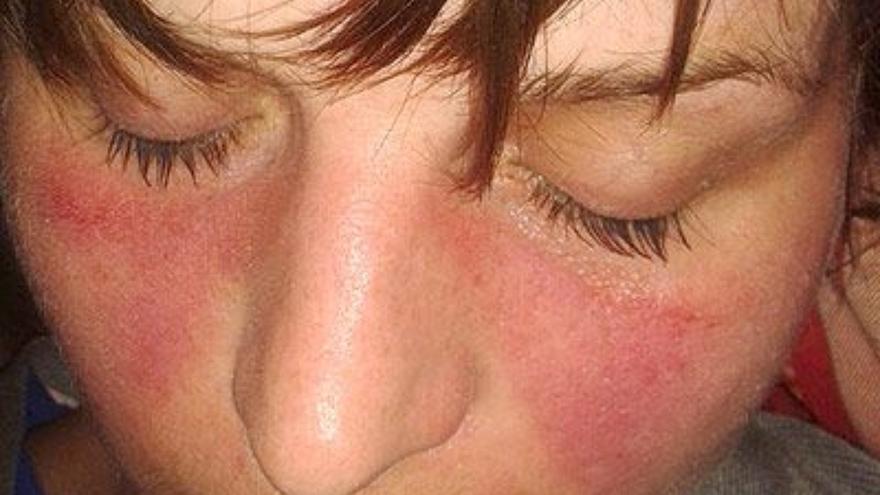 Lupus, así son los síntomas y el tratamiento de una enfermedad femenina de origen desconocido