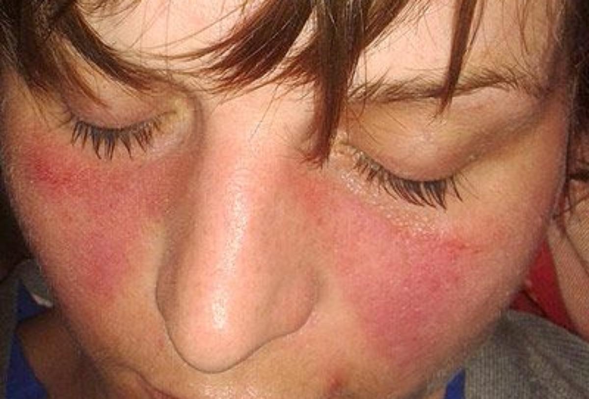 Lupus, así son los síntomas y el tratamiento de una enfermedad femenina de origen desconocido