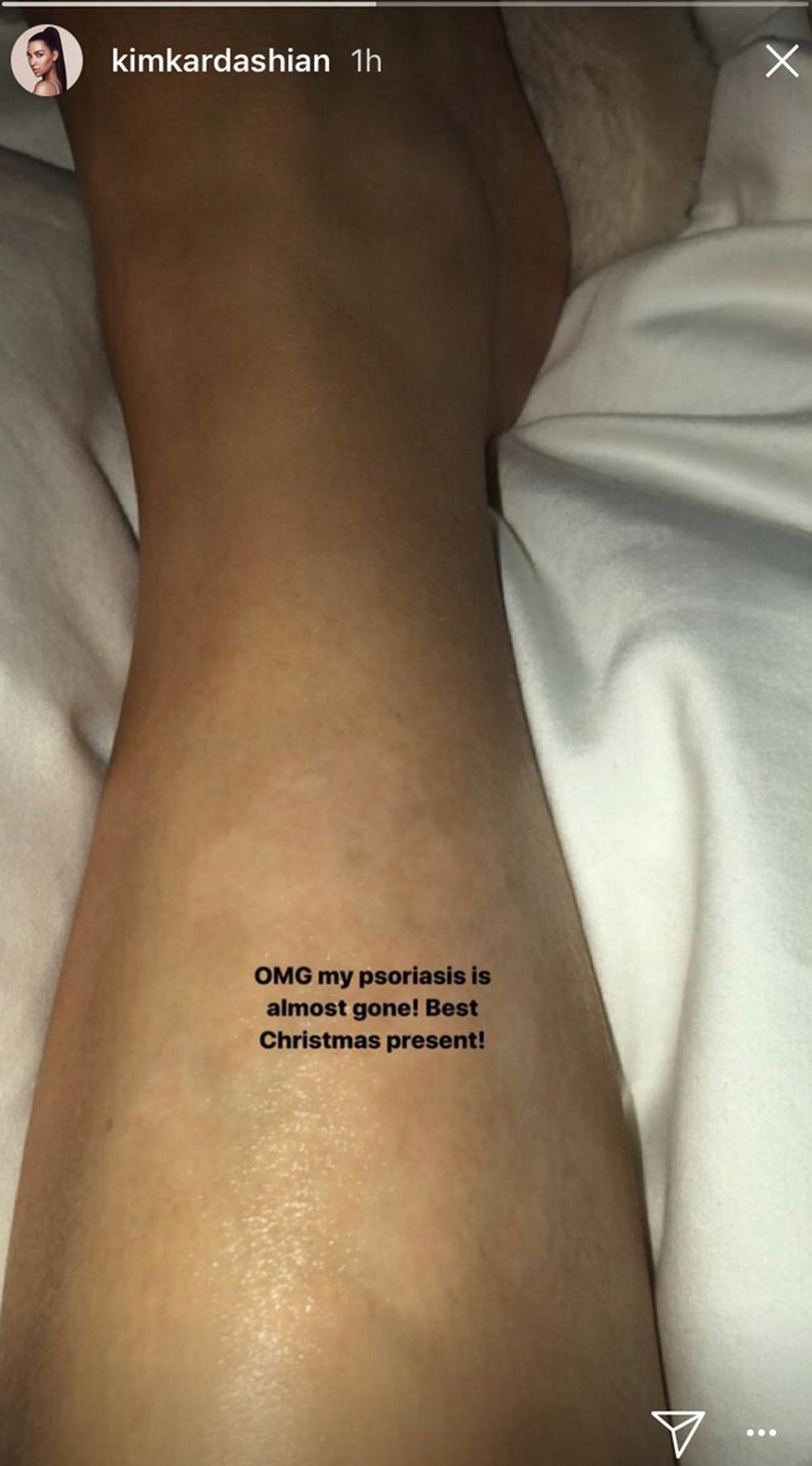 La psoriasis de Kim Kardashian