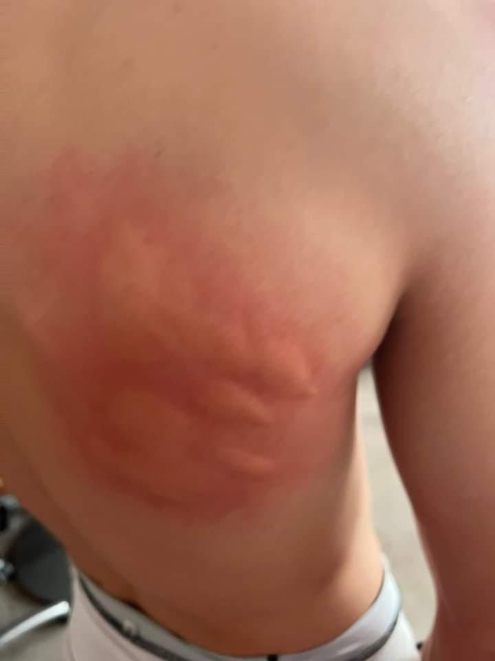 Imagen de la reacción que tuvo de picaduras un joven del Grau.