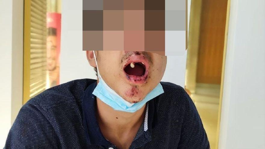 El joven perdió tres dientes por los brutales golpes