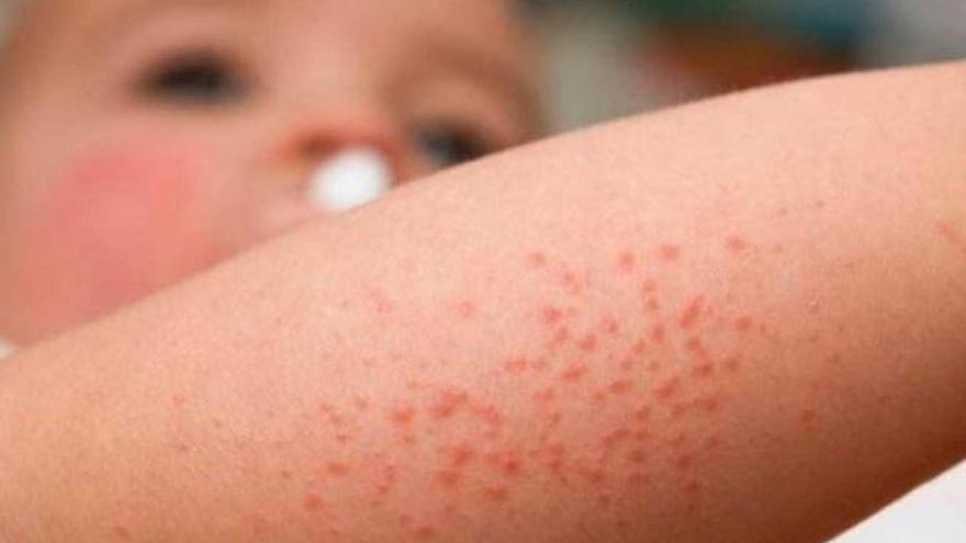 Una muestra de dermatitis atópica. // FdV