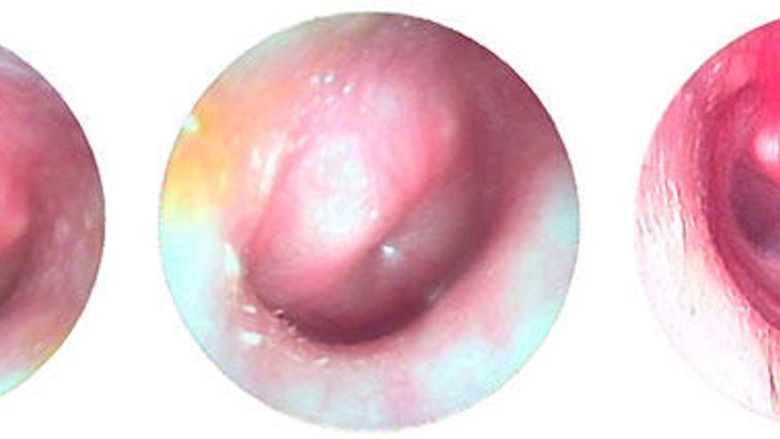 La otitis media aguda es una acumulación de moco y pus en el oído medio.