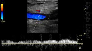 Usar la máquina para tratar apneas reduce en un 30% el riesgo de episodios  cardiovasculares graves - El Periódico