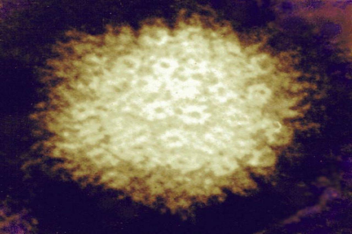 Virus del herpes zoster.