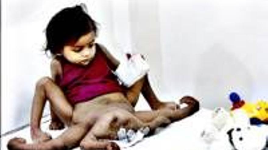 Operan a una niña india con ocho extremidades