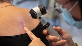L'Hospital Uiversitari d'Igualada fa una vigilància especial de la pell i el càncer