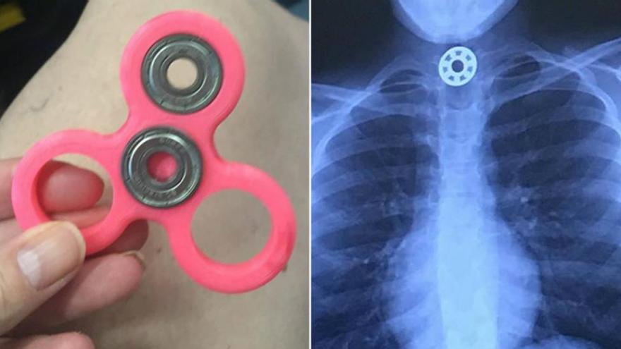 Una niña, intervenida de urgencia por asfixia al tragarse una pieza del Fidget Spinner