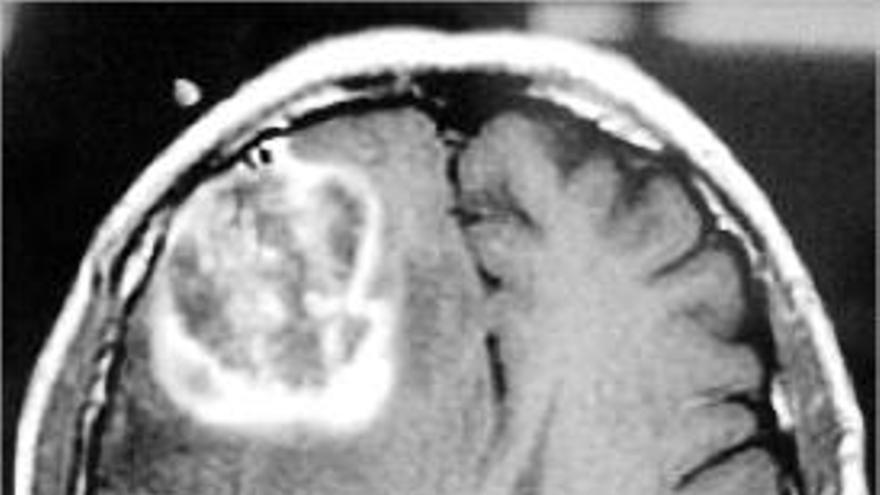 Imatge per ressonància d&#039;un glioblastoma que afecta un cervell humà