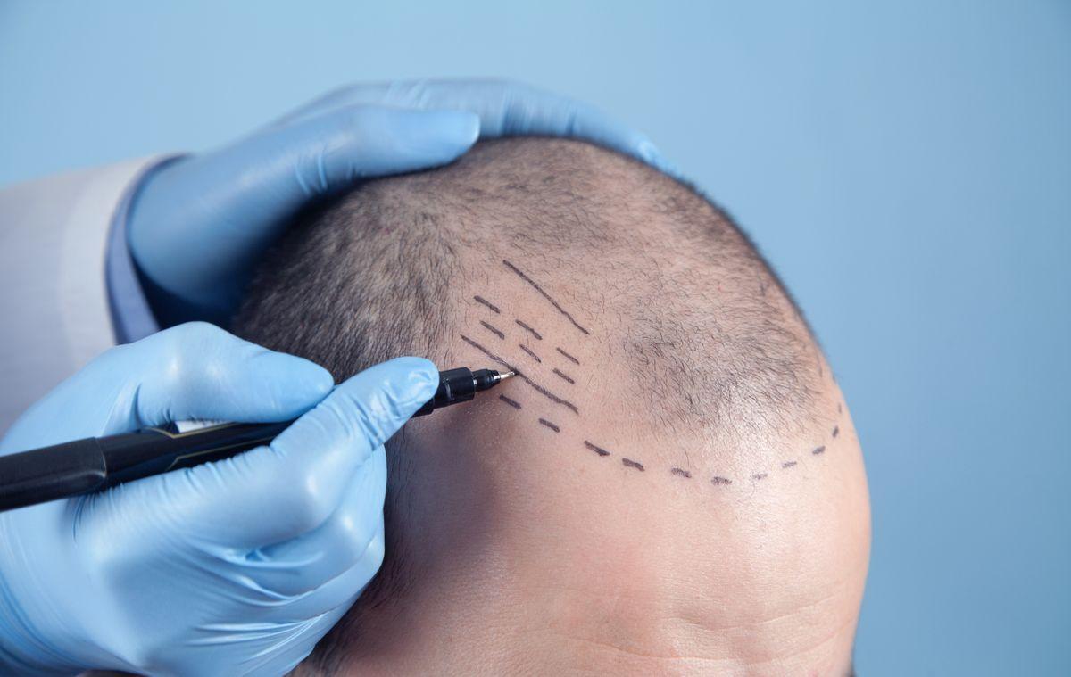 El 90% de los casos de alopecia son de origen androgénico.