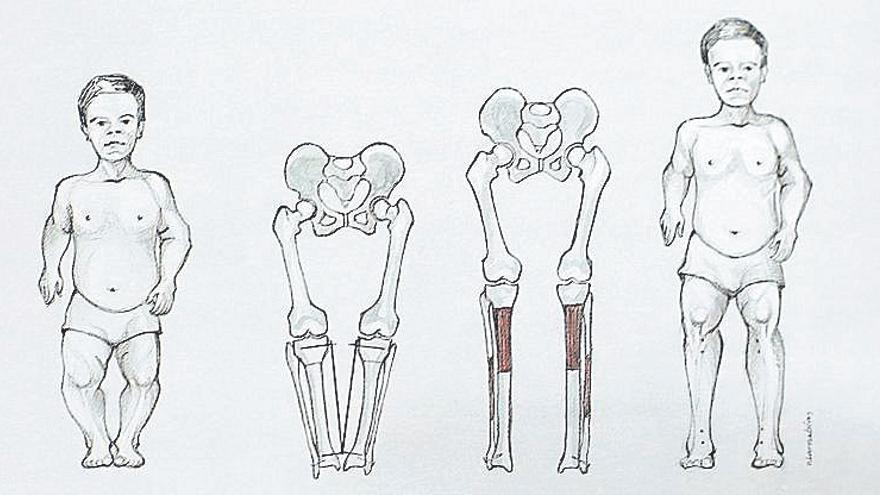 Un dels dibuixos fets pel mateix cirurgià on mostra la seva tècnica per allargar l&#039;alçada de persones de talla baixa