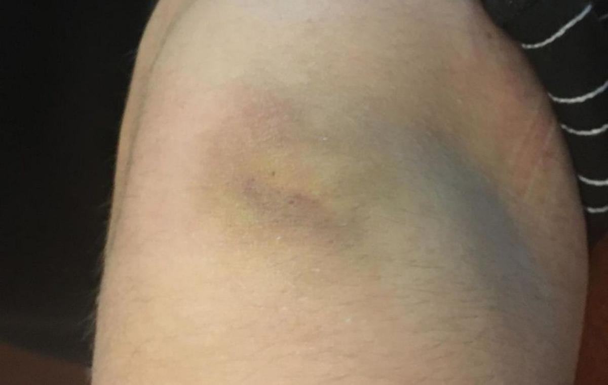 El hematoma en una de las rodillas de la víctima tras ser agredida. | DI