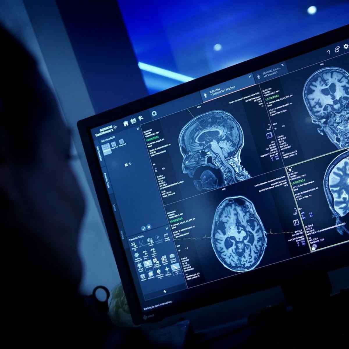 Nova unitat a l’Hospital del Mar per prevenir l’Alzheimer