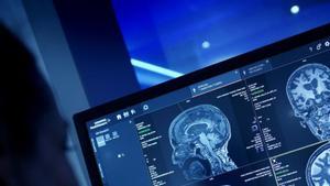 Nova unitat a l’Hospital del Mar per prevenir l’Alzheimer