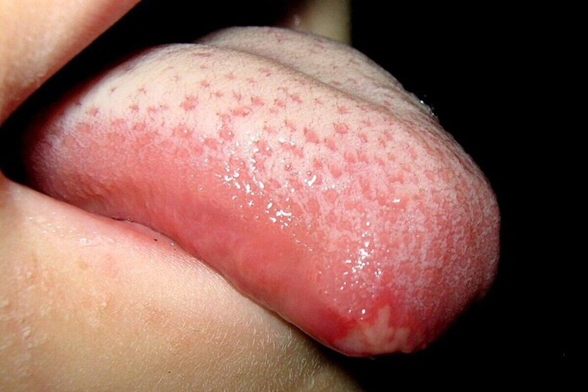 Las llagas en la lengua pueden ser efectos secundarios de algunos tratamientos.