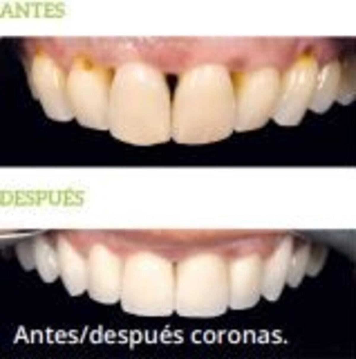 Antes/después coronas