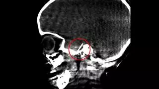 Una operación "inédita": extraen una aguja de dentista del cerebro de una niña de 4 años en Barcelona