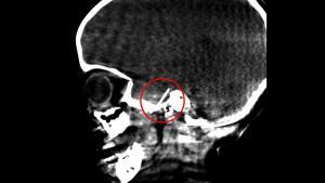 Imagen de la aguja de dentista insertada en el sistema nervioso de la niña de 4 años.