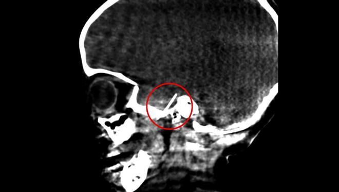 Extraen una aguja de dentista del cerebro de una niña de 4 años en Barcelona