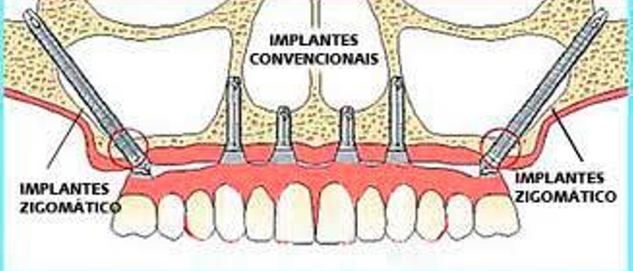 Reproducción de un implante zigomático, que se coloca en la dentadura superior.