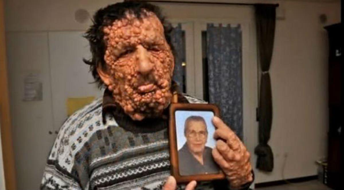 Vinicio Riva, lhome amb neurofibromatosi al qual va abraçar el Papa