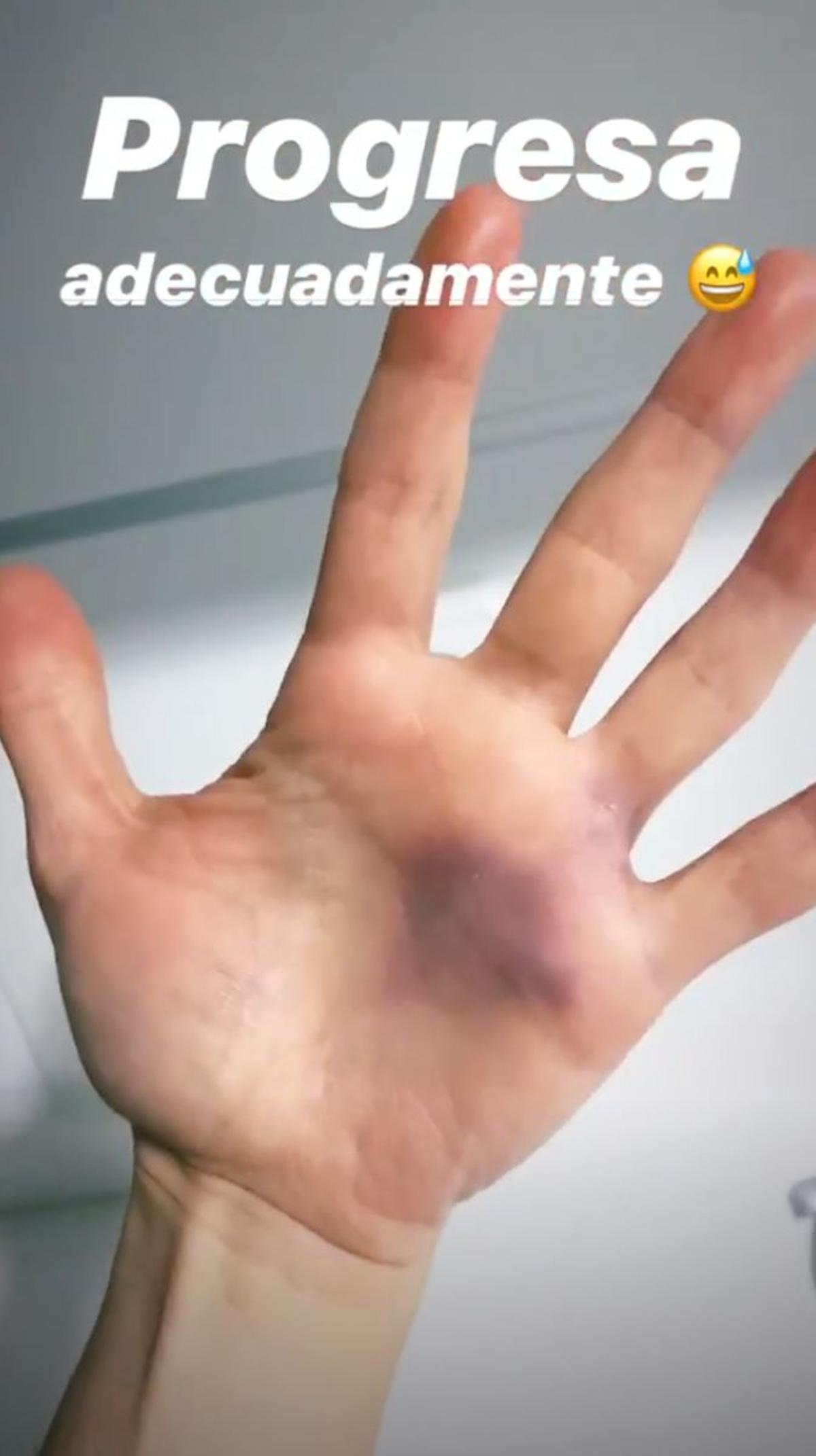 La mano accidentada de Verdeliss