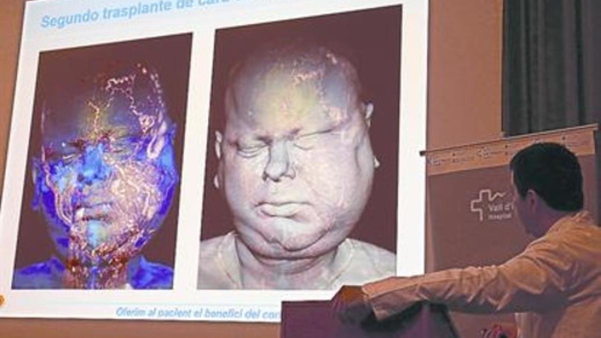 El cirujano Joan Pere Barret muestra la extensión del tumor vascular que ocupaba el rostro del enfermo.