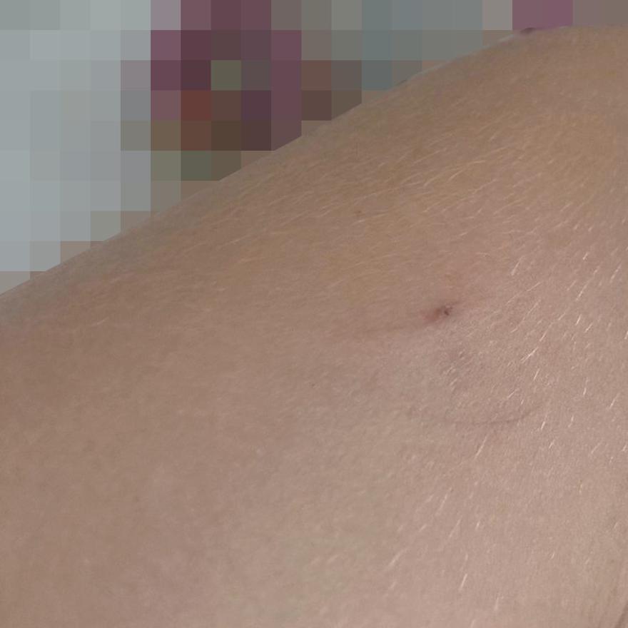 Marca de un pinchazo en el brazo de una joven que ha denunciado un agresión de este tipo.